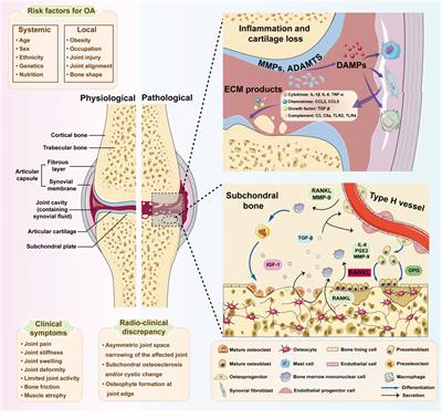 Editorial: Novel insights about subchondral bone remodeling in arthropathies